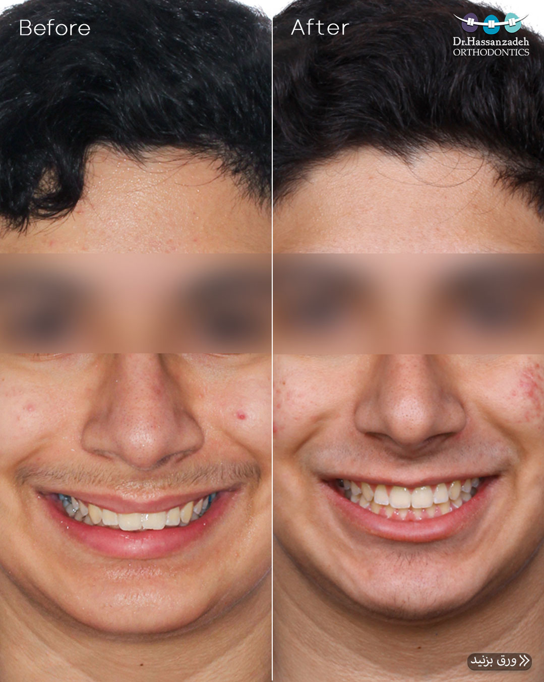 قبل و بعد از درمان