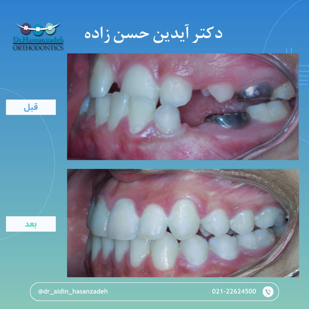 قبل و بعد از درمان اورتودنسی