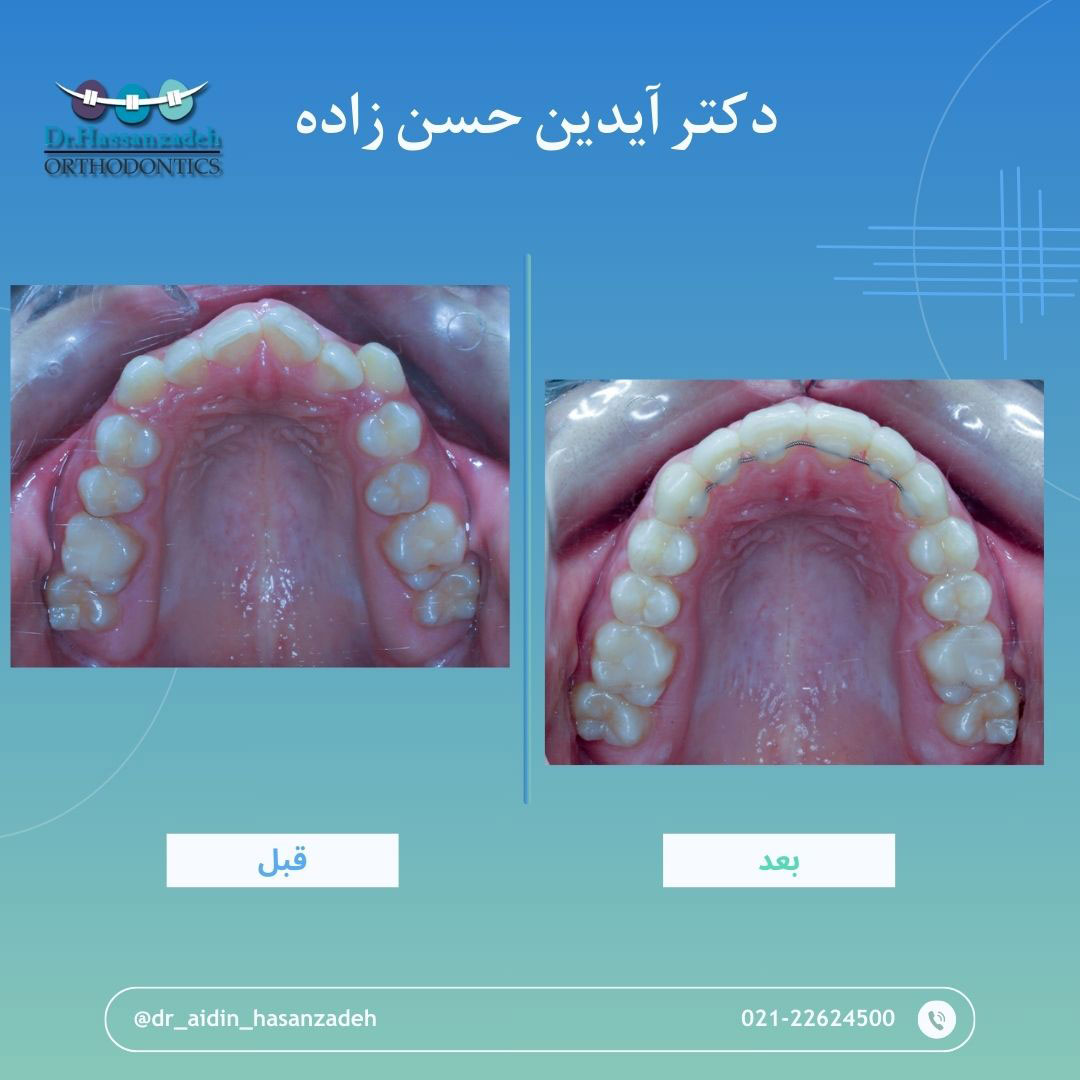 قبل و بعد از درمان اورتودنسی