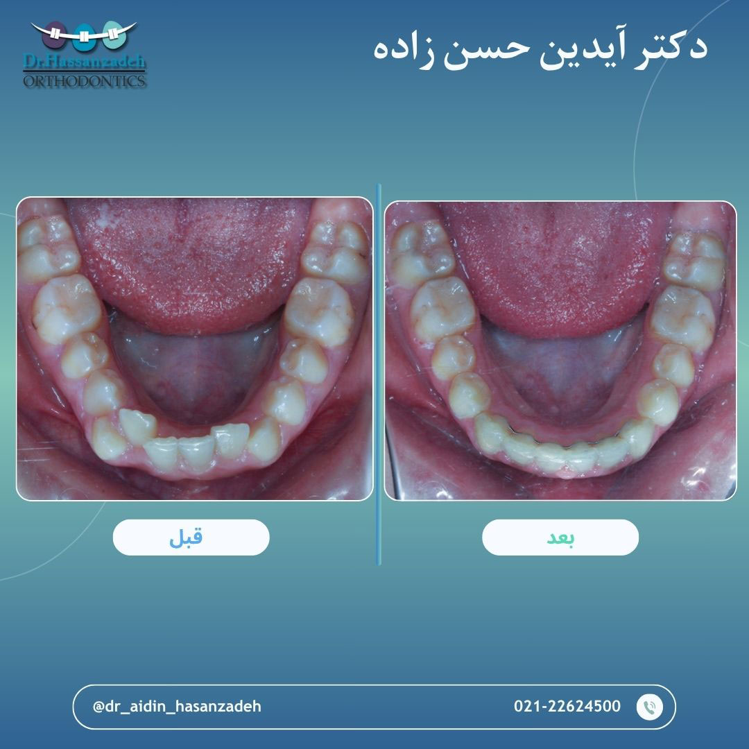 قبل و بعد از درمان اورتودنسی