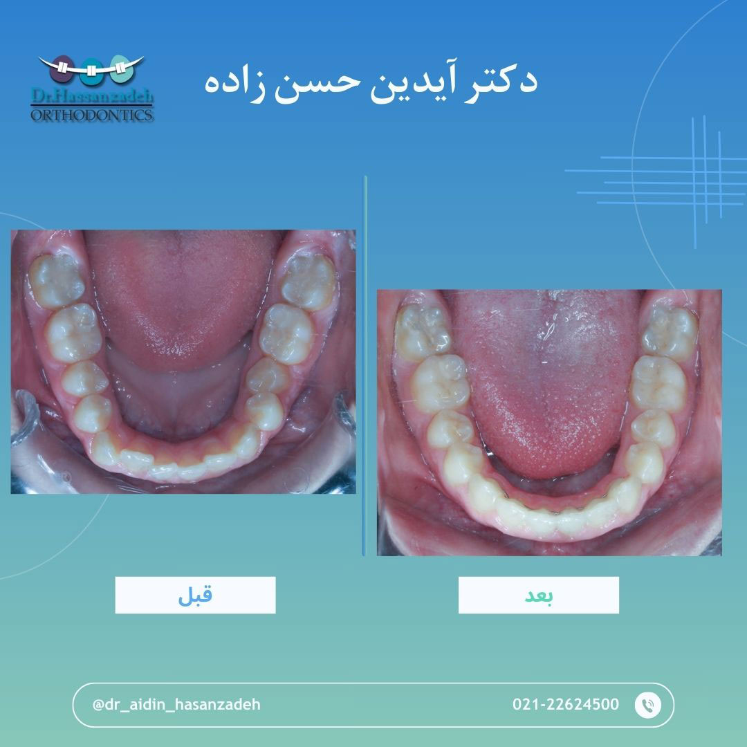 قبل و بعد از درمان اورتودنسی