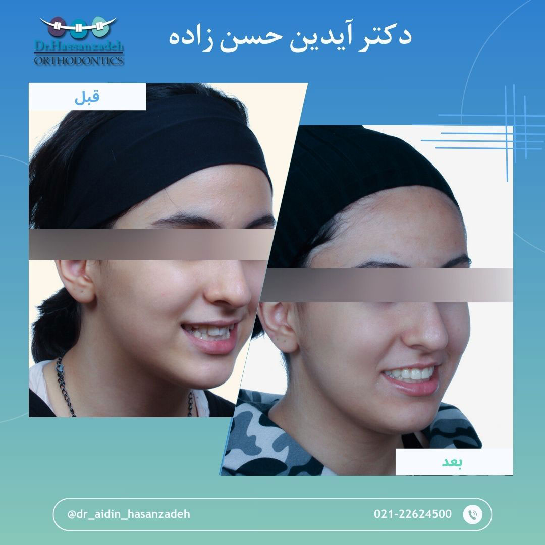 قبل و بعد از درمان اورتودنسی