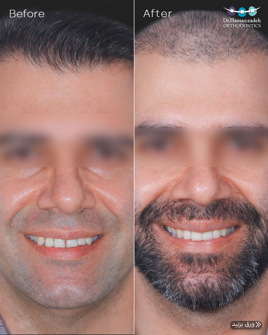 قبل و بعد از درمان