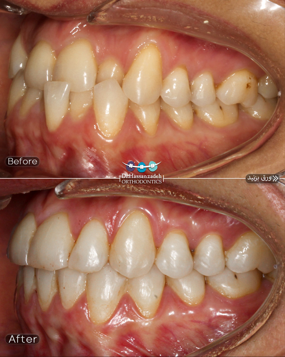قبل و بعد از درمان اورتودنسی