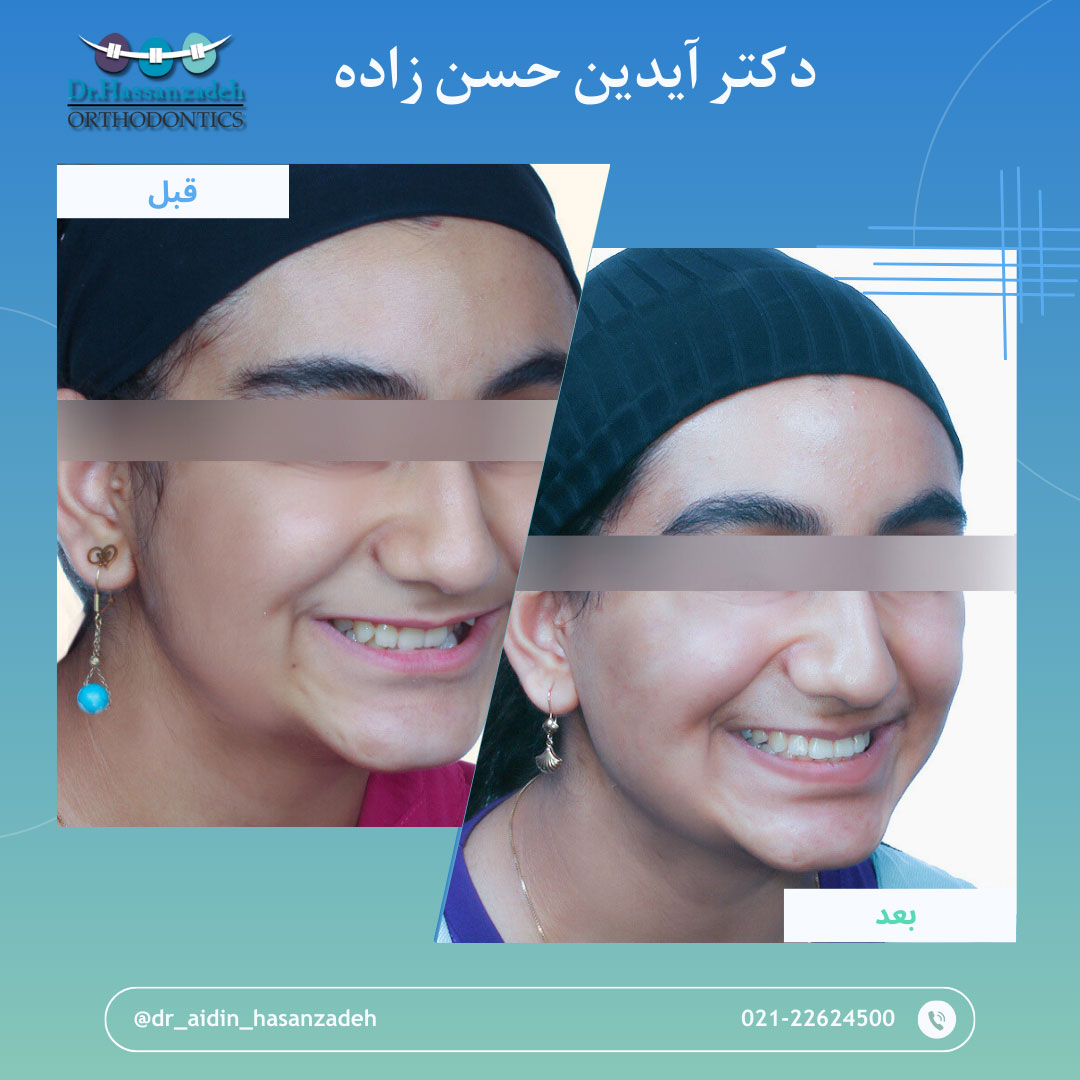 قبل و بعد از درمان اورتودنسی