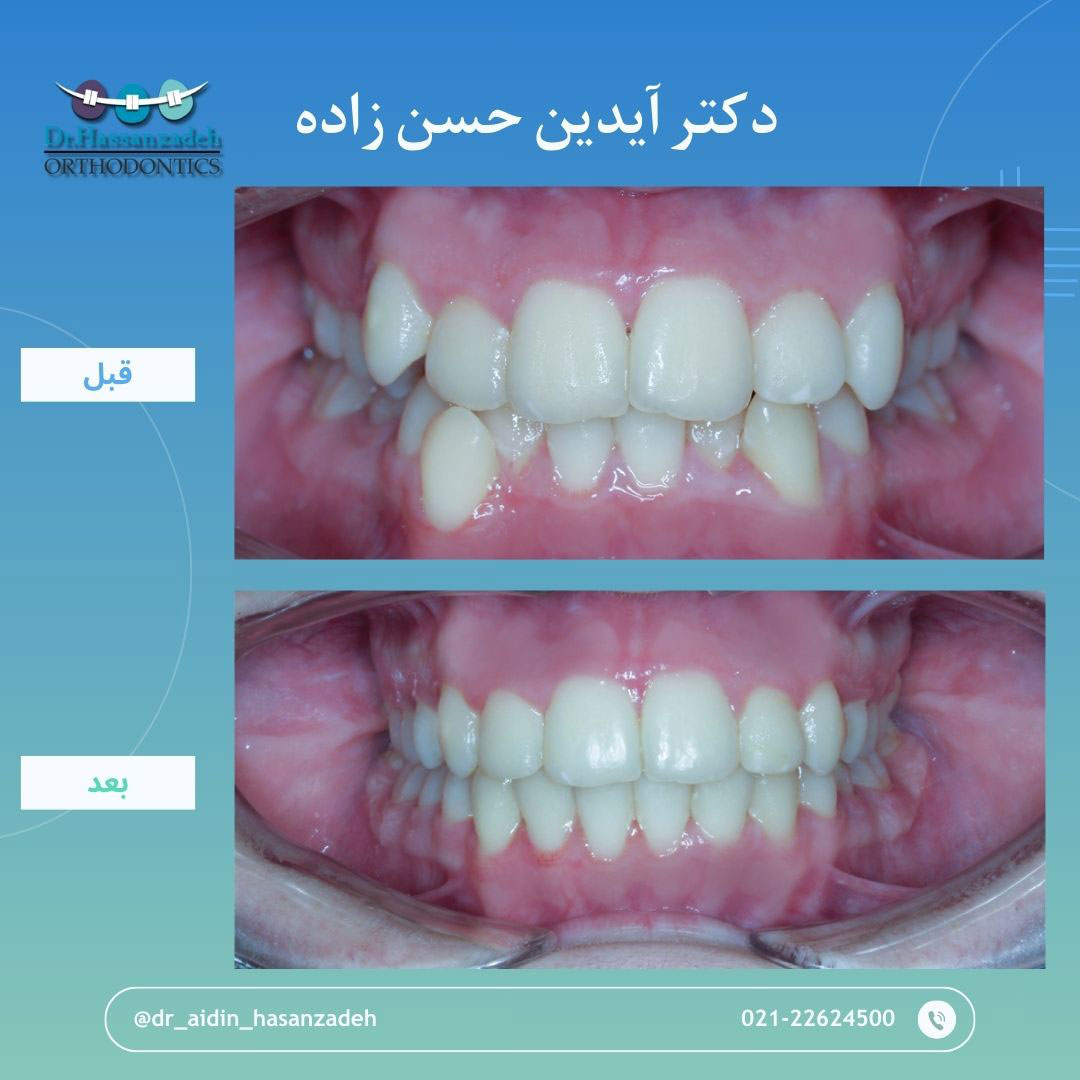 قبل و بعد از درمان اورتودنسی