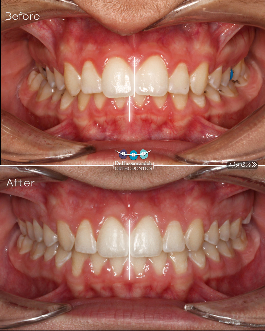 قبل و بعد از درمان اورتودنسی