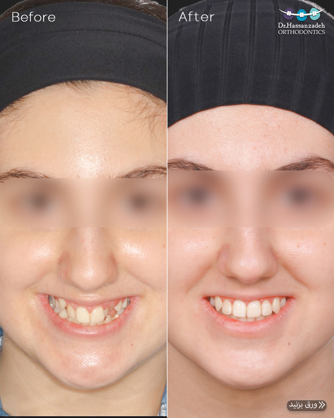 قبل و بعد از درمان