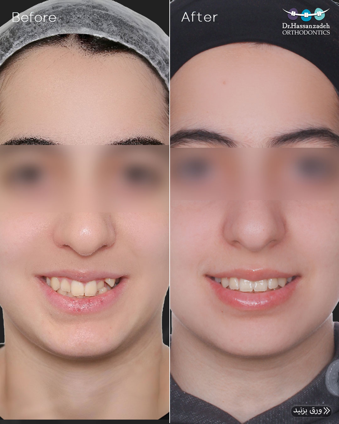 قبل و بعد از درمان