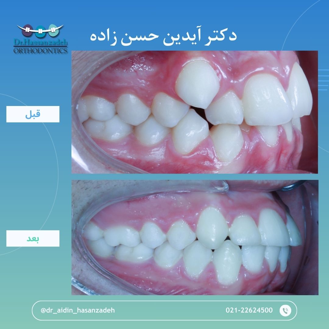 قبل و بعد از درمان اورتودنسی