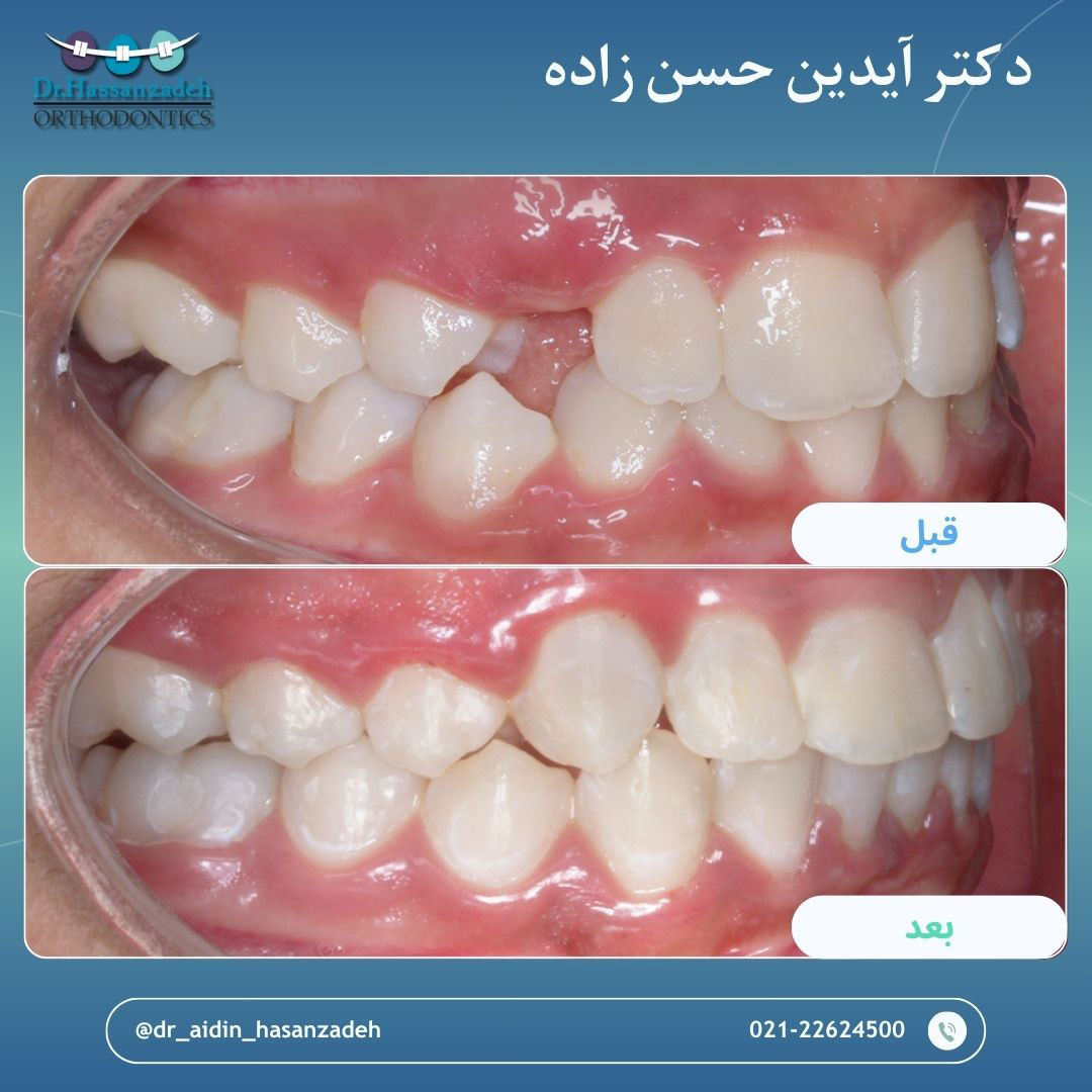 قبل و بعد از درمان اورتودنسی