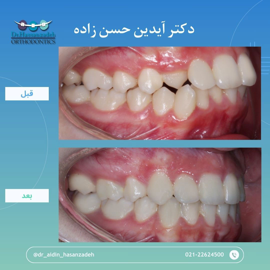 قبل و بعد از درمان اورتودنسی