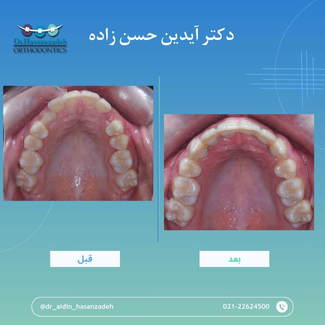 قبل و بعد از درمان اورتودنسی