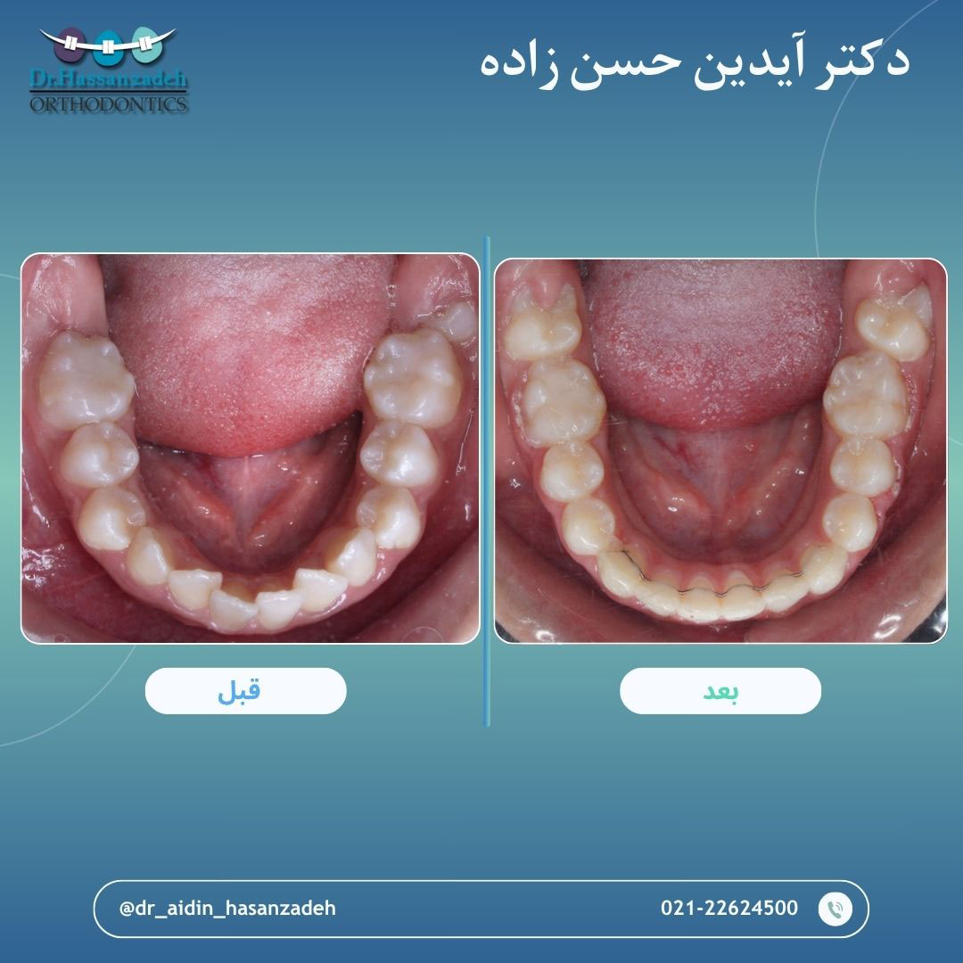 قبل و بعد از درمان اورتودنسی