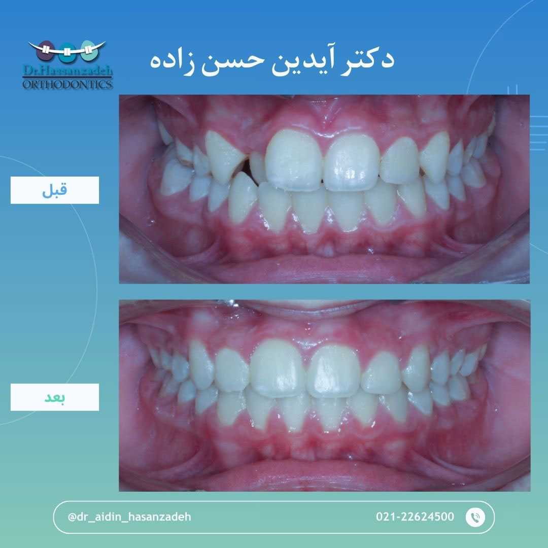 قبل و بعد از درمان اورتودنسی