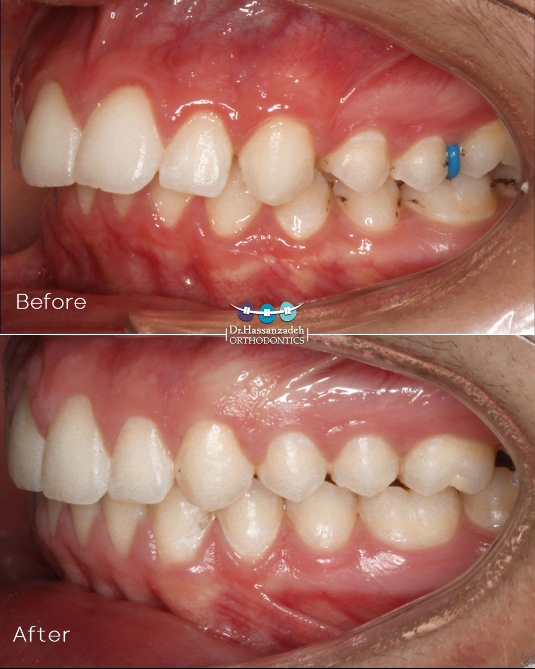قبل و بعد از درمان اورتودنسی