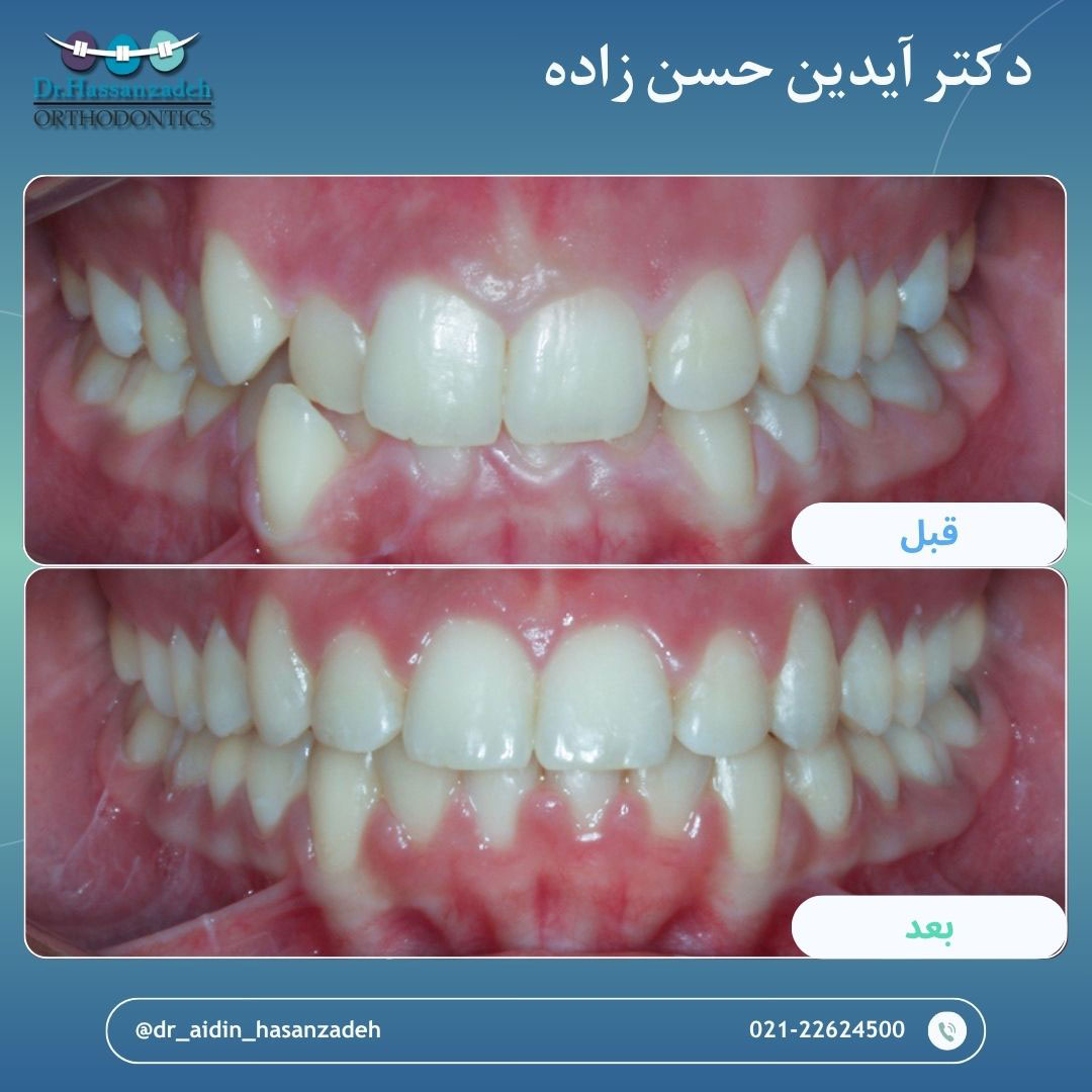 قبل و بعد از درمان اورتودنسی