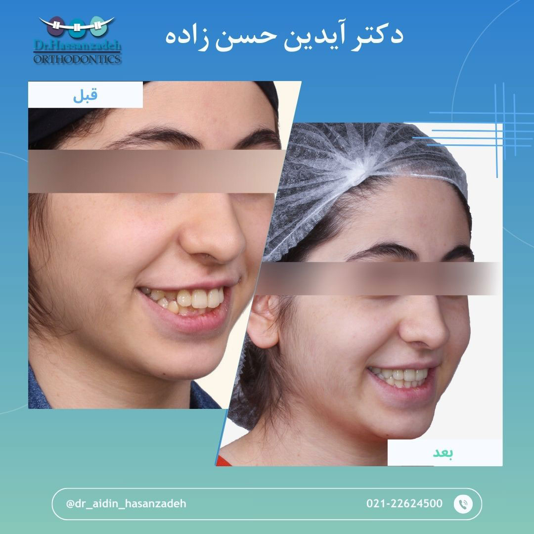 قبل و بعد از درمان اورتودنسی