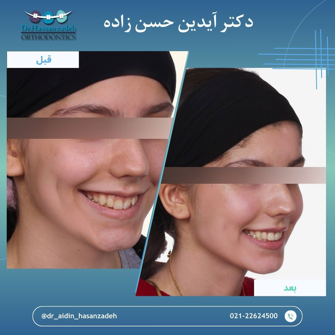 قبل و بعد از درمان اورتودنسی