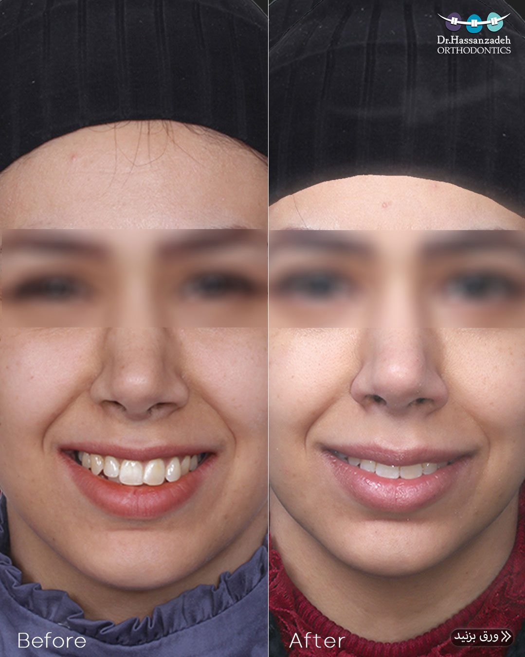 قبل و بعد از درمان