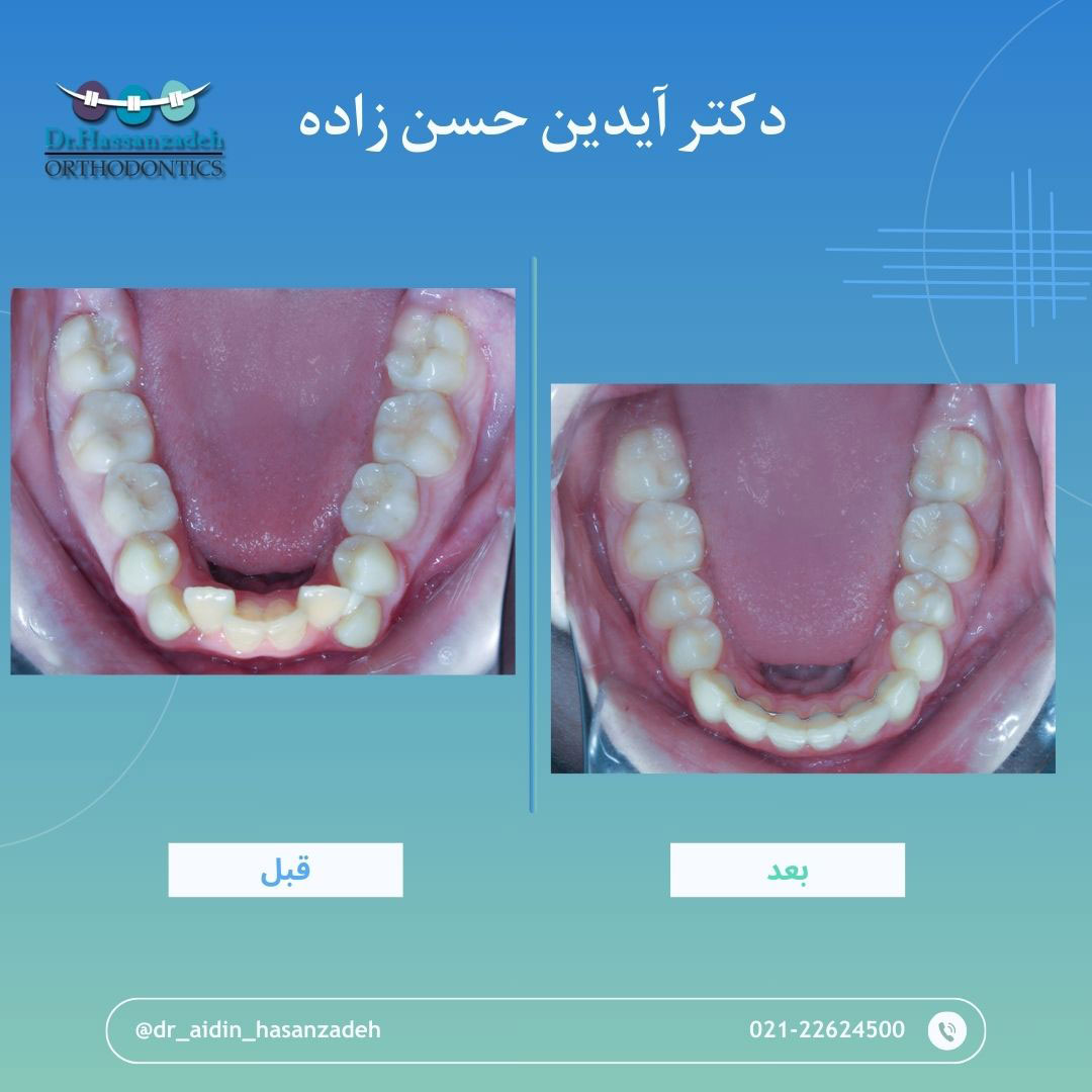 قبل و بعد از درمان اورتودنسی