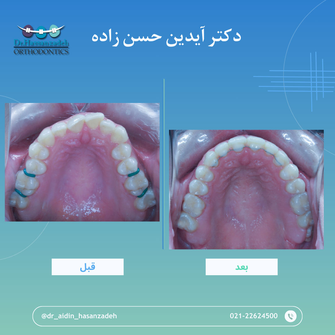 قبل و بعد از درمان اورتودنسی