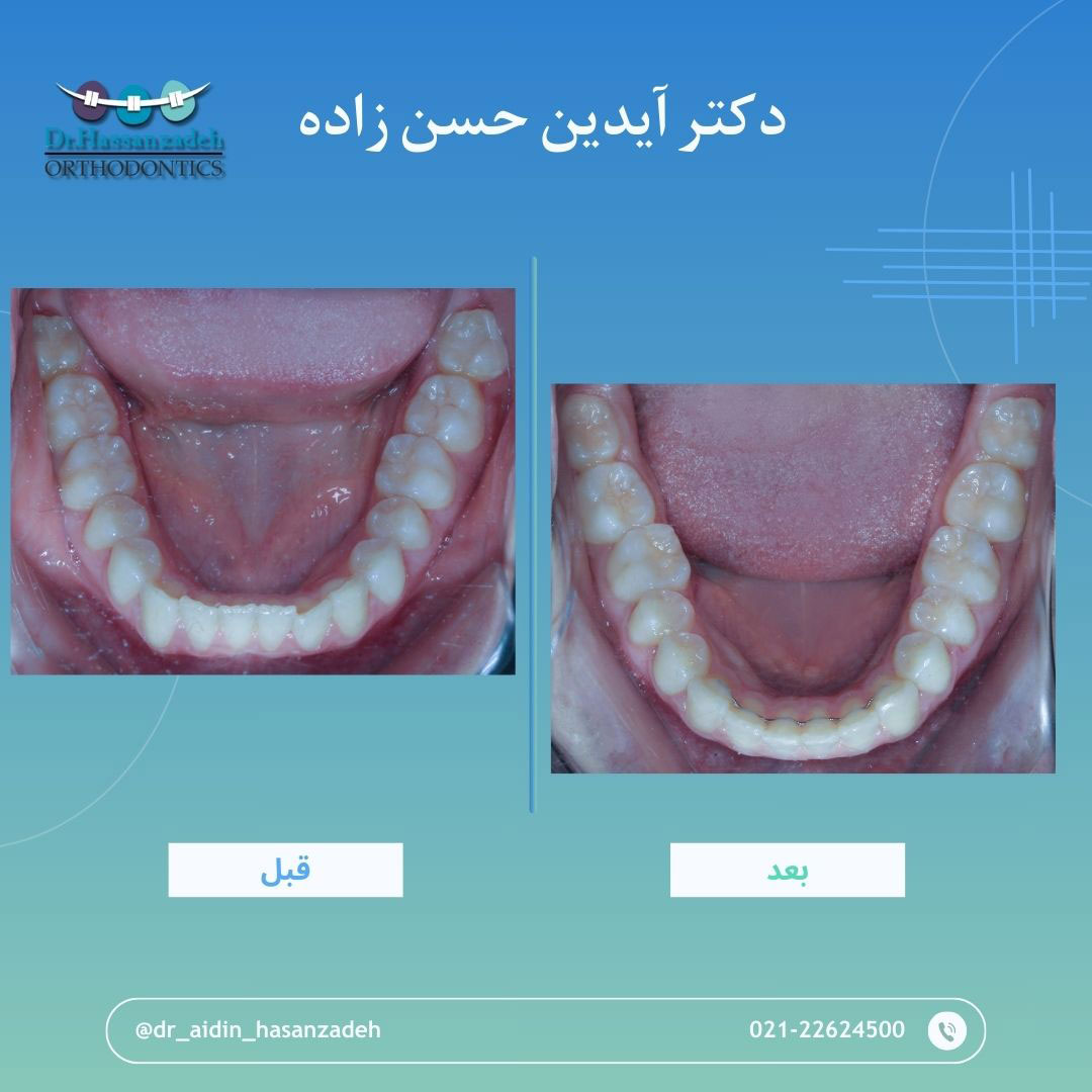 قبل و بعد از درمان اورتودنسی