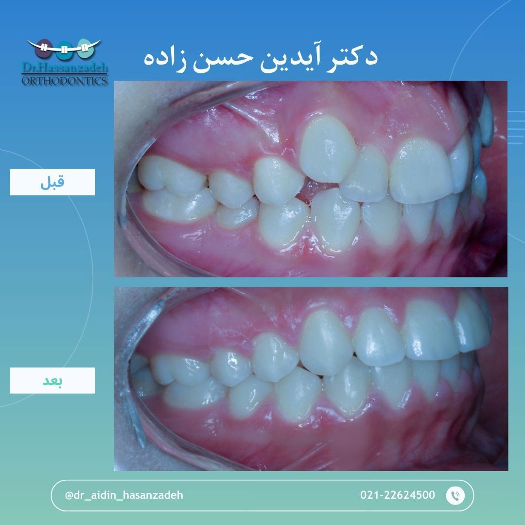 قبل و بعد از درمان اورتودنسی