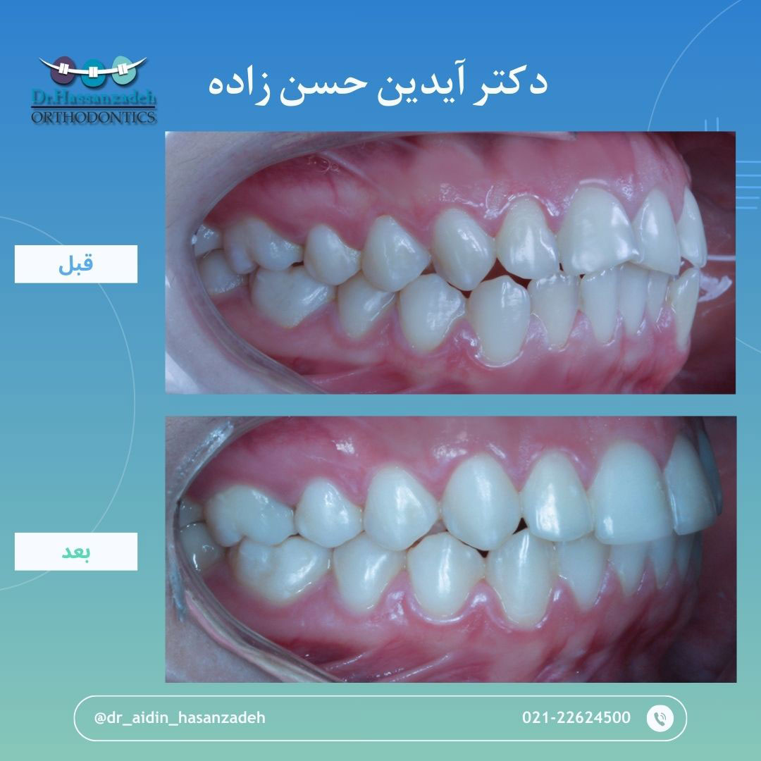 قبل و بعد از درمان اورتودنسی