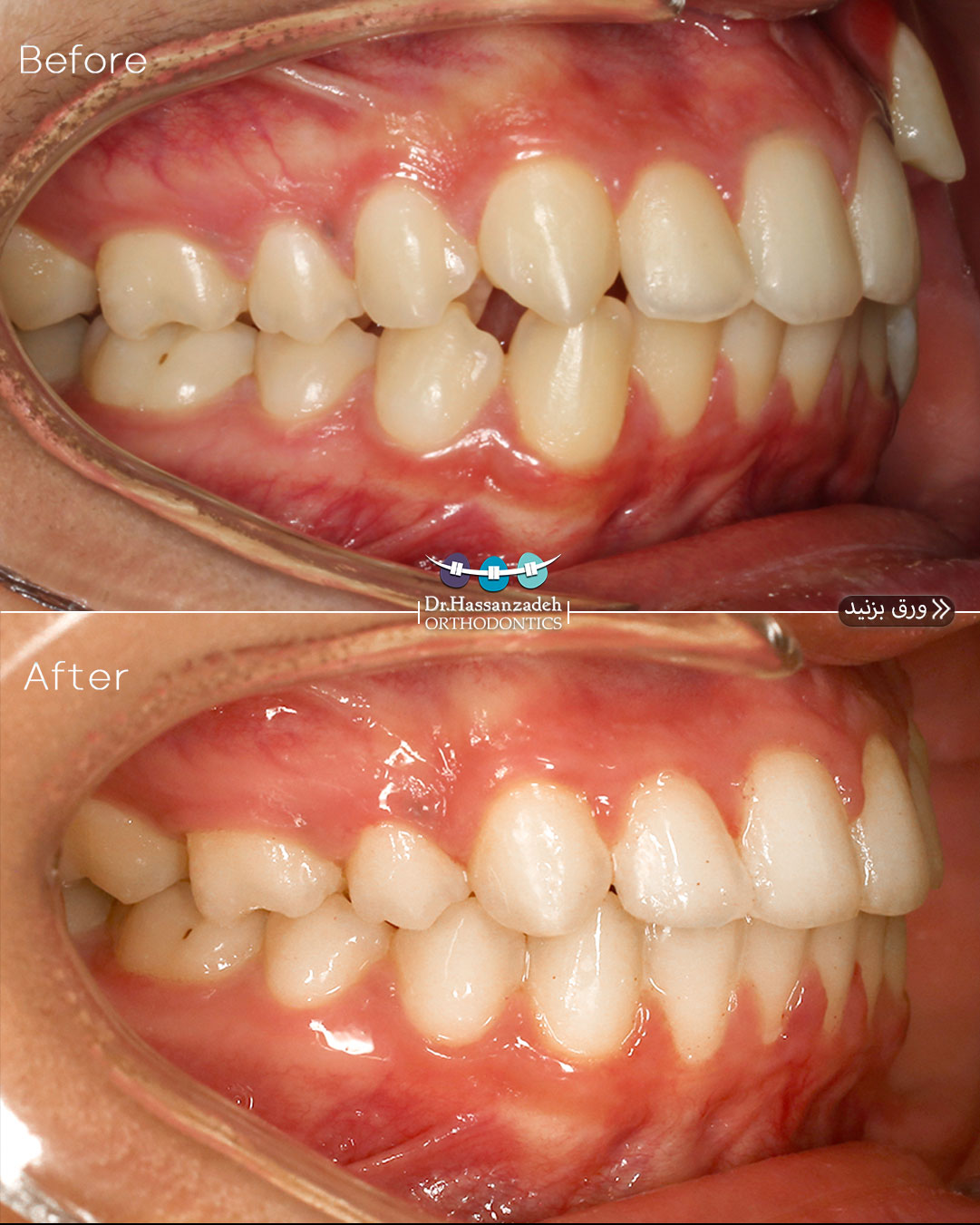 قبل و بعد از درمان اورتودنسی