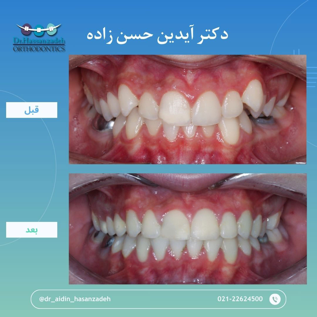 قبل و بعد از درمان اورتودنسی