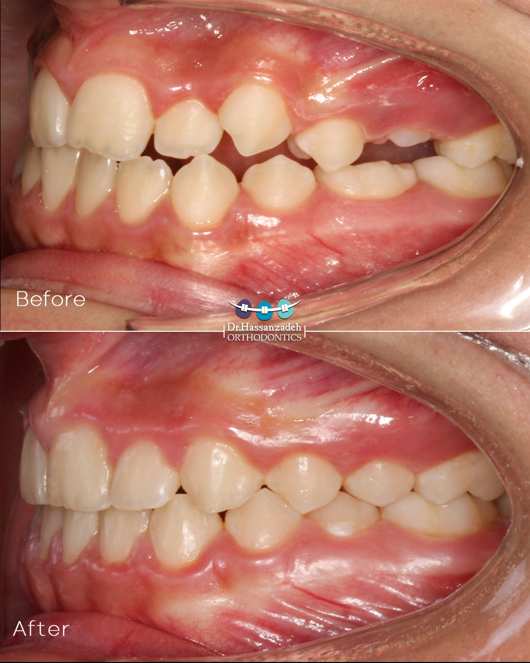 قبل و بعد از درمان اورتودنسی