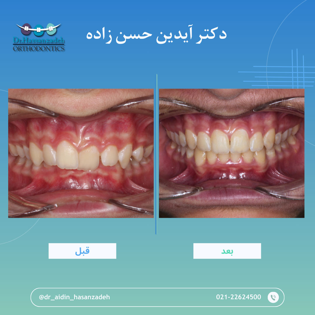 قبل و بعد از درمان اورتودنسی