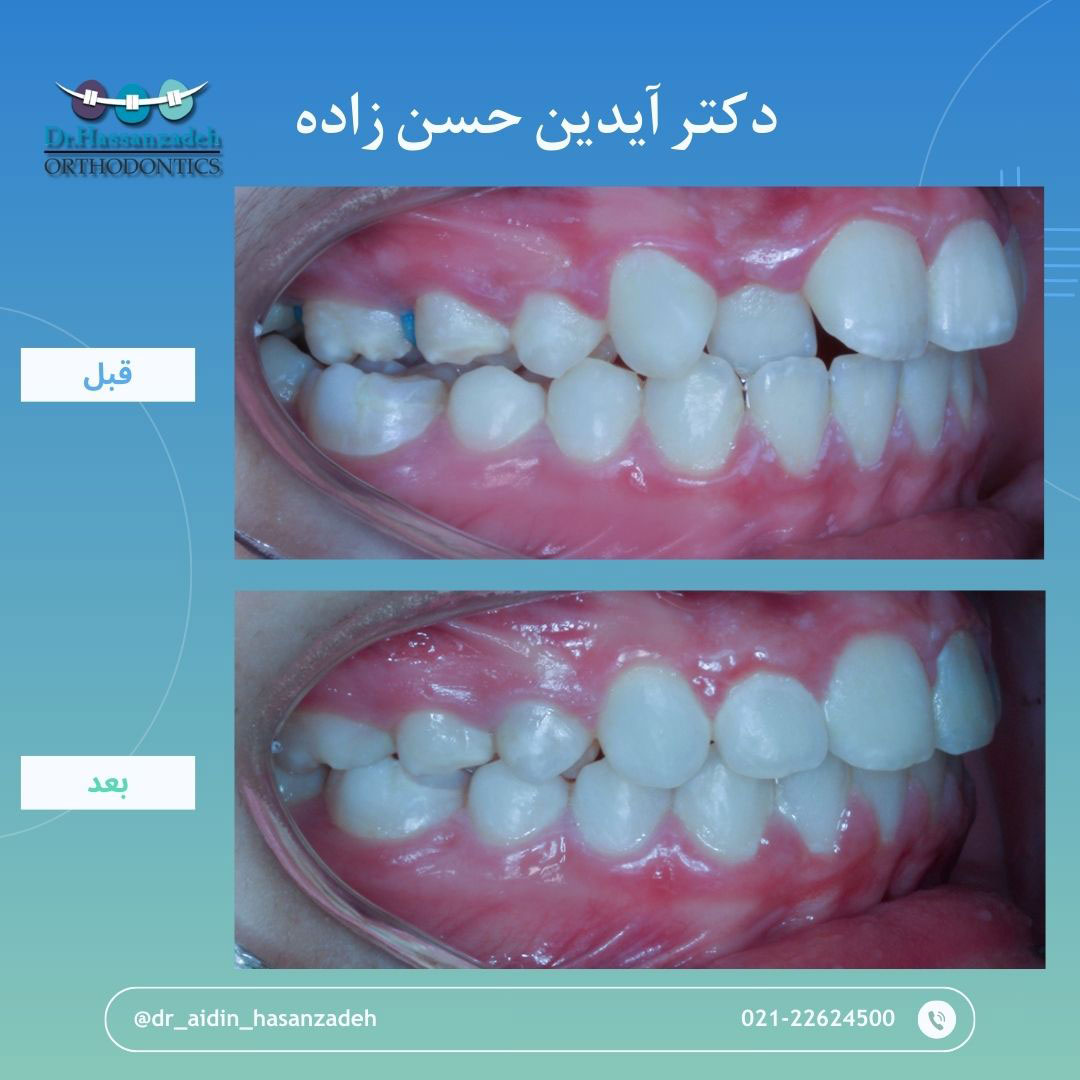 قبل و بعد از درمان اورتودنسی