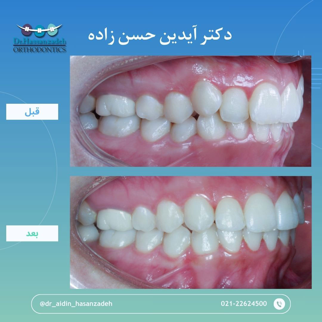 قبل و بعد از درمان اورتودنسی