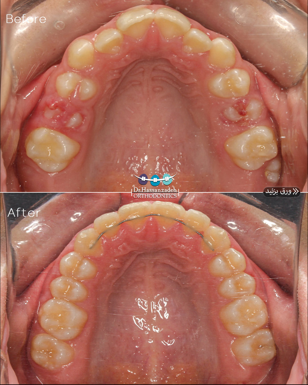 قبل و بعد از درمان اورتودنسی