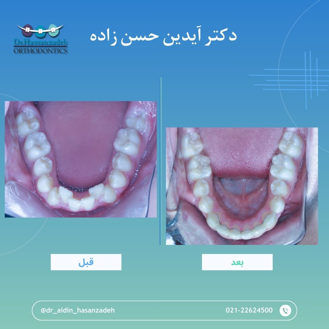 قبل و بعد از درمان اورتودنسی