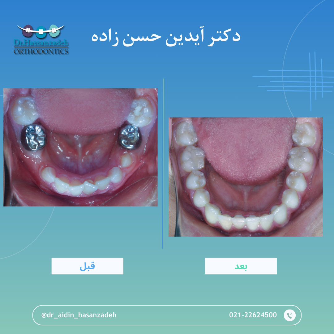 قبل و بعد از درمان اورتودنسی