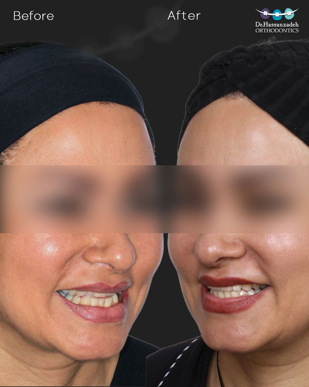 قبل و بعد از درمان اورتودنسی