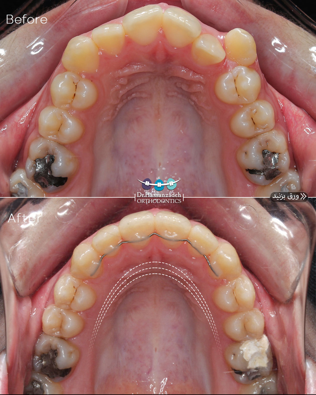 قبل و بعد از درمان اورتودنسی