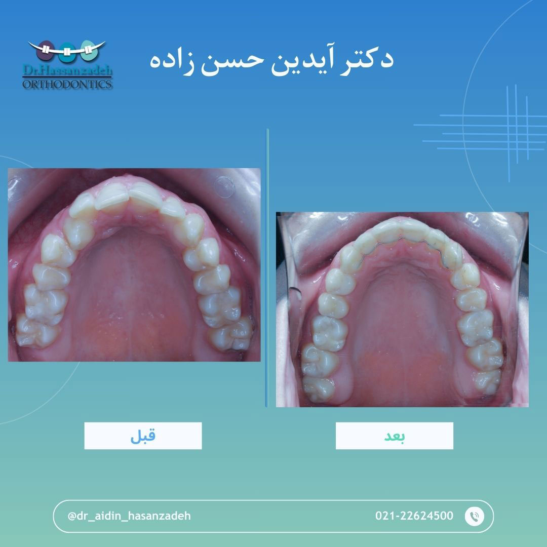 قبل و بعد از درمان اورتودنسی