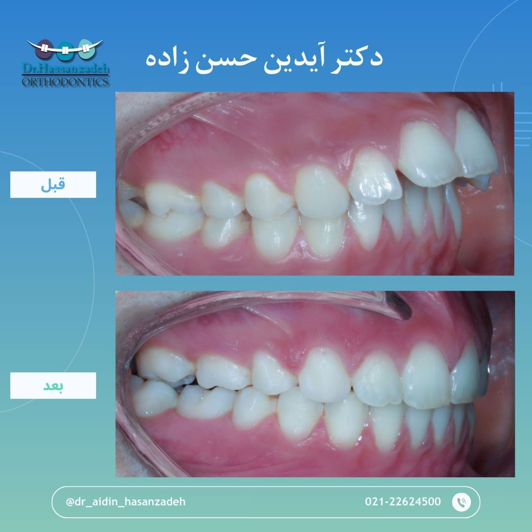 قبل و بعد از درمان اورتودنسی