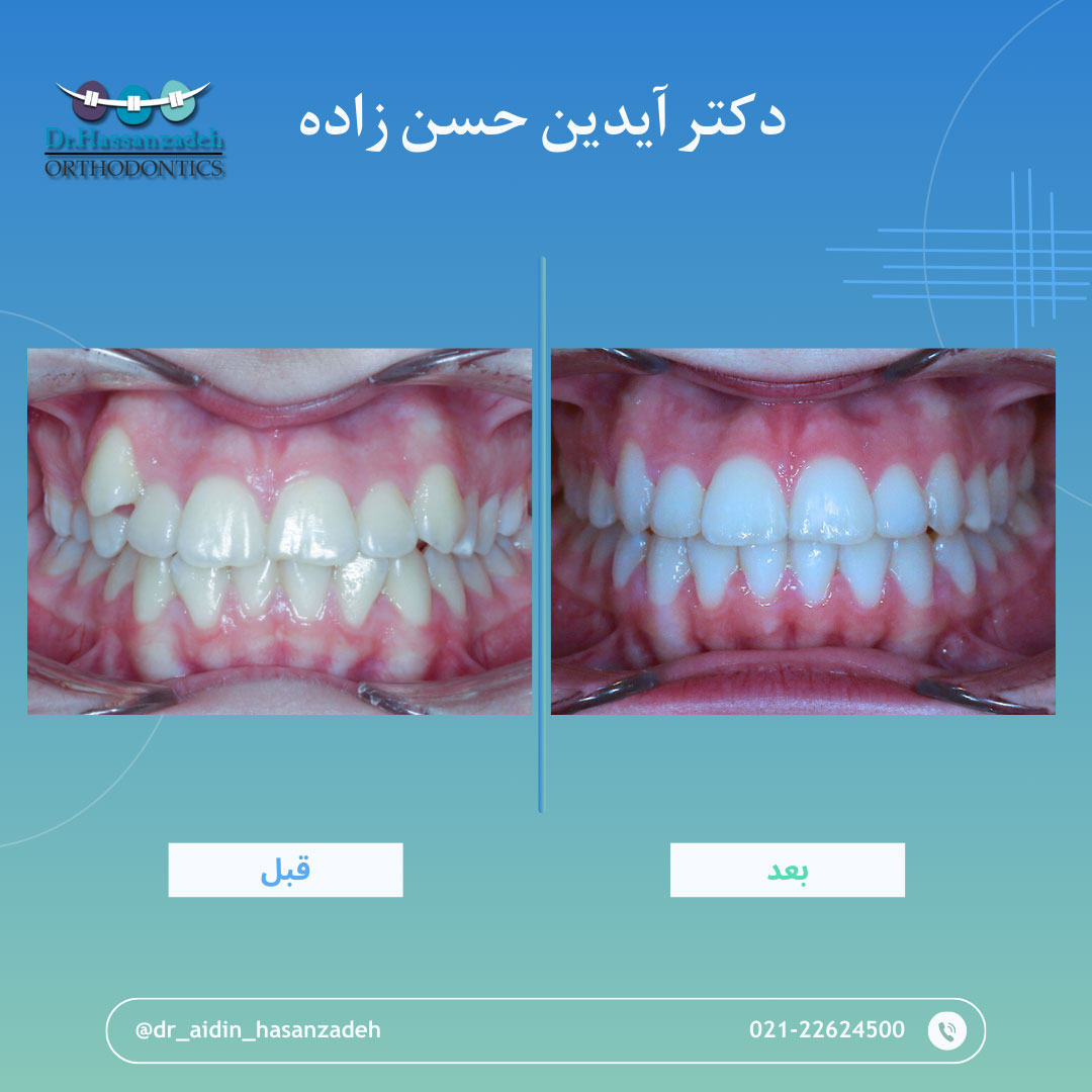 قبل و بعد از درمان اورتودنسی