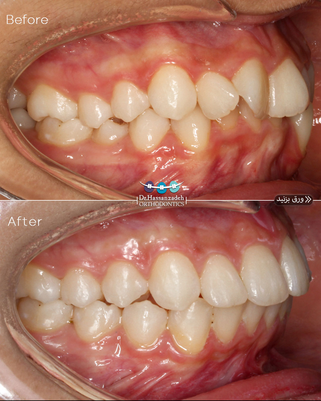 قبل و بعد از درمان اورتودنسی