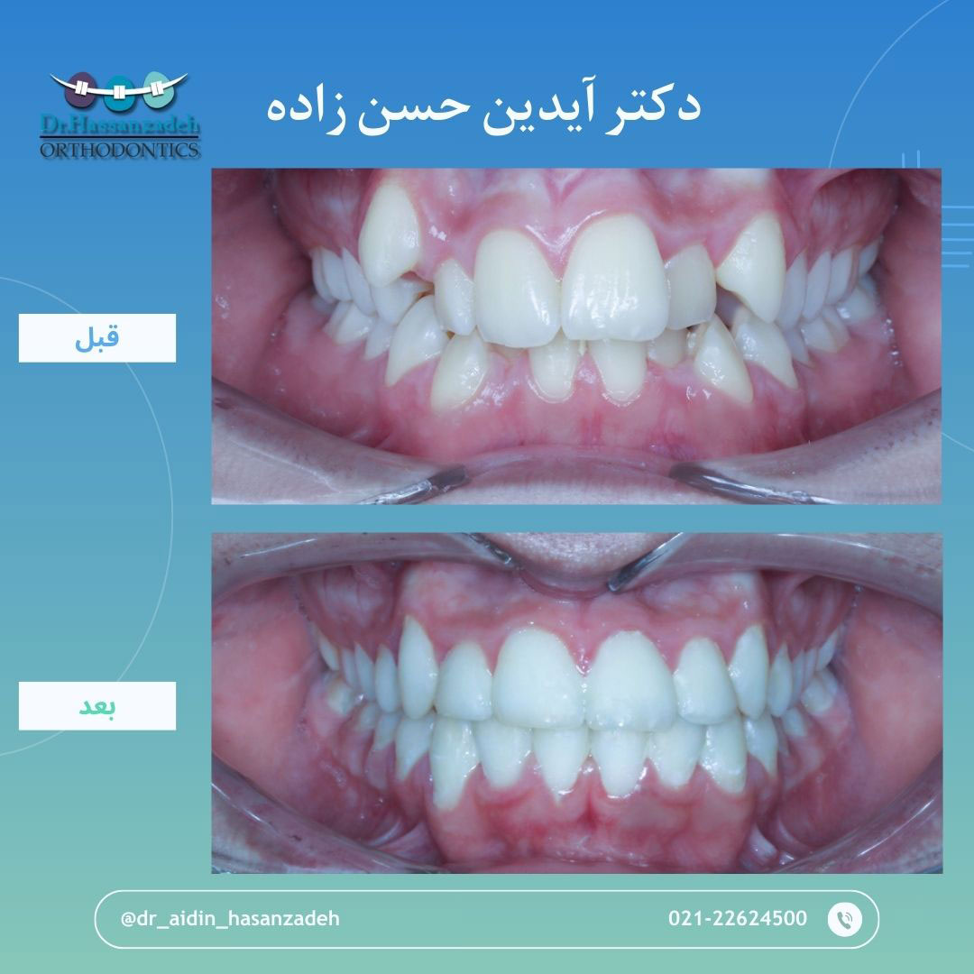 قبل و بعد از درمان اورتودنسی