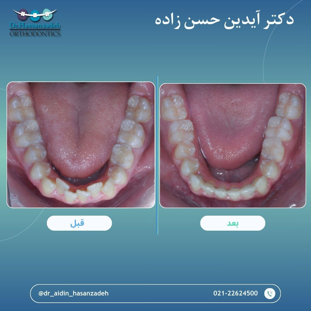 قبل و بعد از درمان اورتودنسی