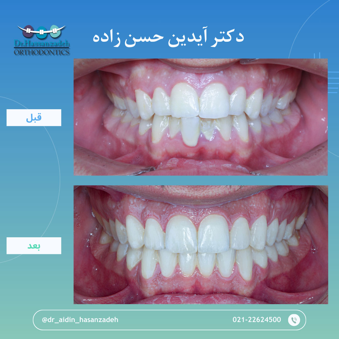 قبل و بعد از درمان اورتودنسی