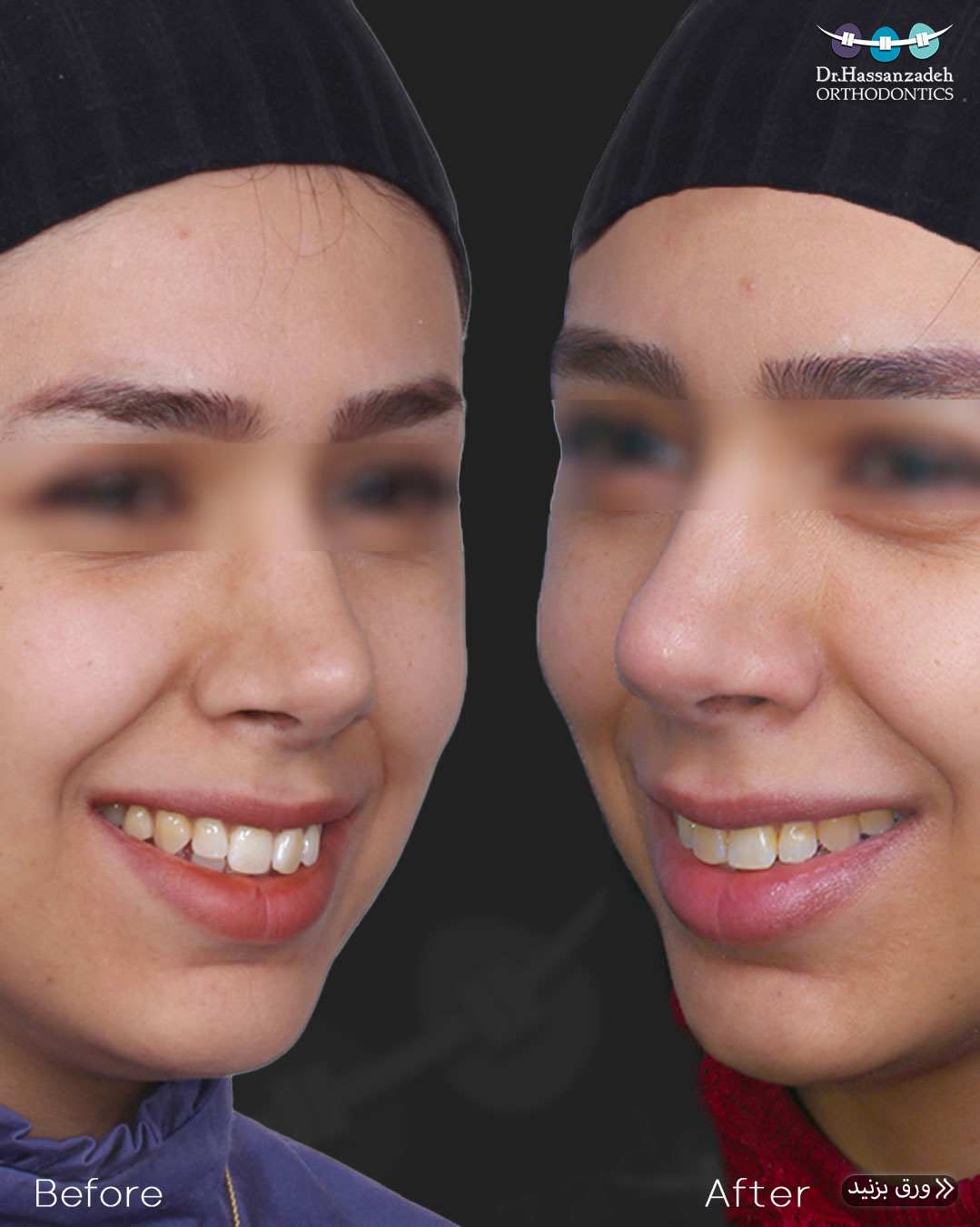 قبل و بعد از درمان اورتودنسی